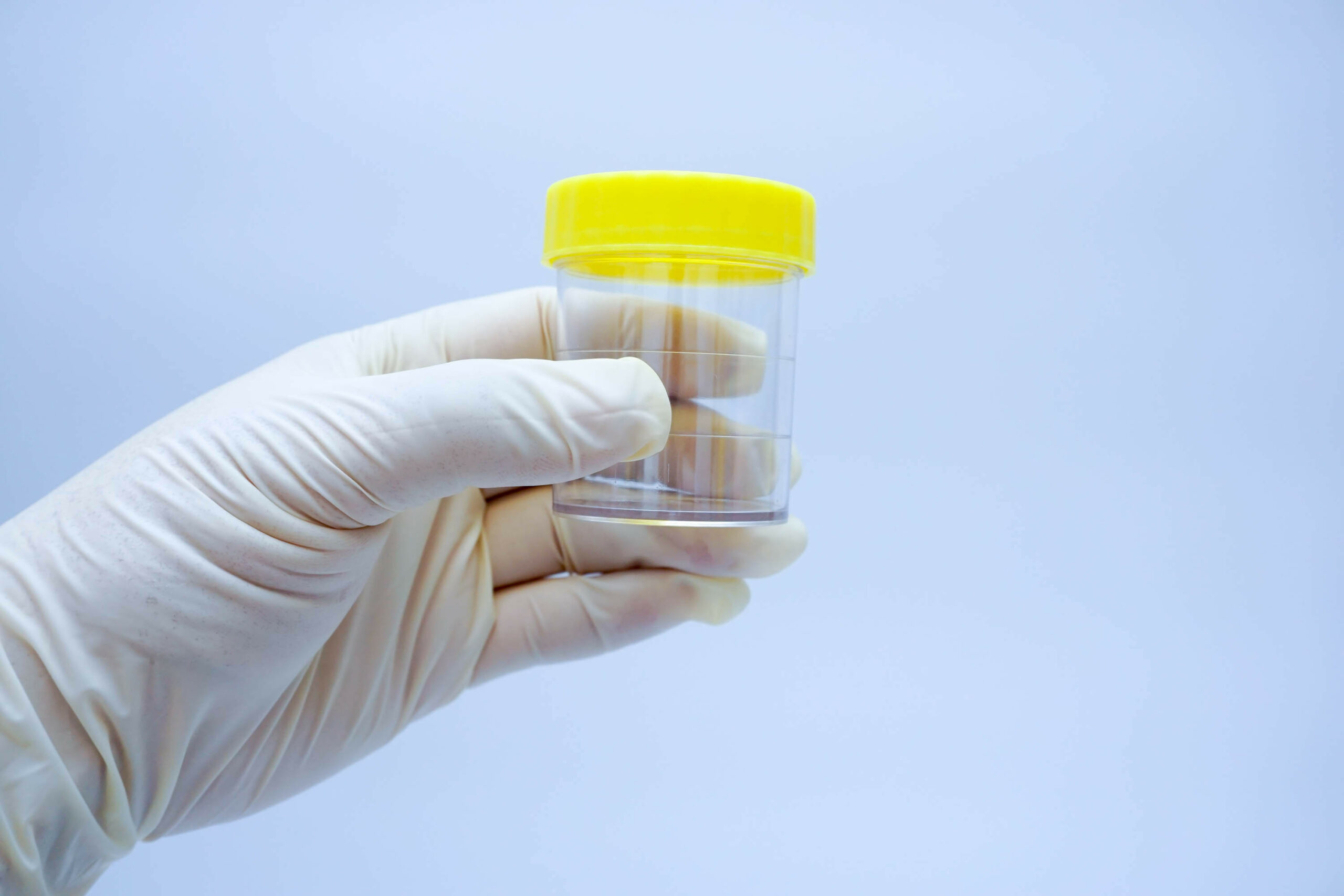 Hand with medical gloves holding Urine sample container